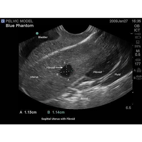 Blue Phantom General Pathology Transvaginal Ultrasound Training Model ...