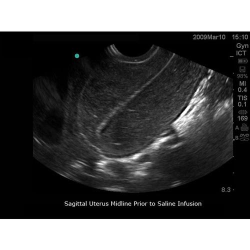 Blue Phantom Transvaginal SonoHysterography and Sonosalpingography ...