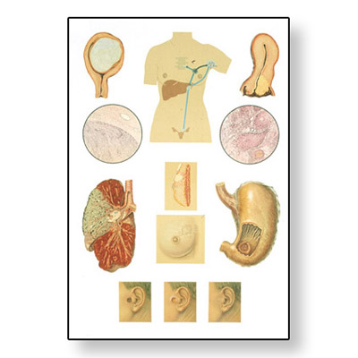 Cancer Chart - V2044U - Cancers - 3B Scientific