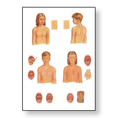 Childhood Infectious Diseases Chart - V2070M - 1001228 - Parasitic ...