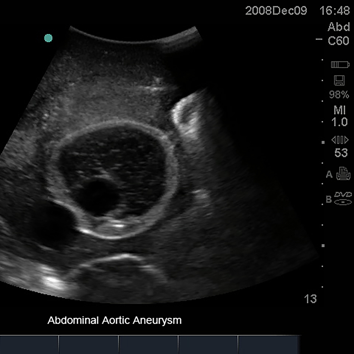 Abdominal Aorta Ultrasound