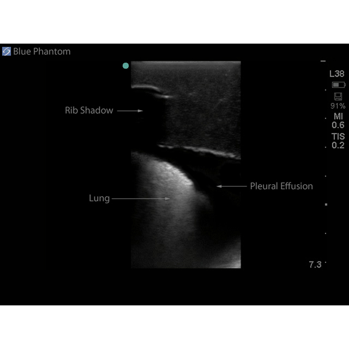 Blue Phantom Midscapular Thoracentesis Ultrasound Training Model ...