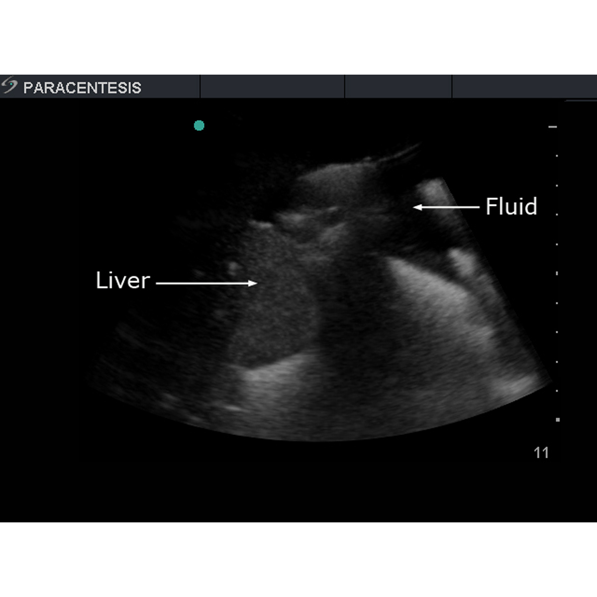 Blue Phantom Paracentesis Ultrasound Replacement Tissue Insert ...